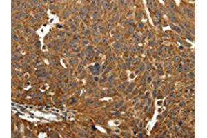 The image on the left is immunohistochemistry of paraffin-embedded Human ovarian cancer tissue using ABIN7129340(EIF2AK3 Antibody) at dilution 1/40, on the right is treated with fusion protein. (COQ3 Antikörper)