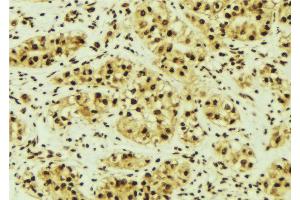 ABIN6268996 at 1/100 staining Human breast cancer tissue by IHC-P.