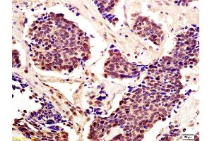 Formalin-fixed and paraffin embedded human lung carcinoma with labeled Anti-Cytomegalovirus pp65 Polyclonal Antibody, Unconjugated (ABIN738276) at 1:200, followed by conjugation to the secondary antibody and DAB staining