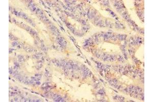 Immunohistochemistry of paraffin-embedded human endometrial cancer using ABIN7142866 at dilution of 1:100
