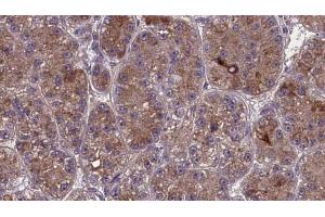 ABIN6273981 at 1/100 staining Human liver cancer tissue by IHC-P. (OR2S2 Antikörper  (C-Term))