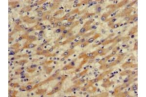 Immunohistochemistry of paraffin-embedded human liver cancer using ABIN7170287 at dilution of 1:100 (SLCO1B1 Antikörper  (AA 426-537))