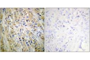 Immunohistochemistry analysis of paraffin-embedded human prostate carcinoma tissue, using Prostate-specific Antigen Antibody. (Prostate Specific Antigen Antikörper  (AA 81-130))