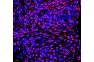 Immunofluorescence of paraffin embedded human cervical cancer using PABPN1 (ABIN7075116) at dilution of 1:600 (400x lens) (PABPN1 Antikörper)