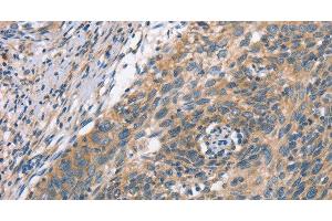 Immunohistochemistry of paraffin-embedded Human cervical cancer using PLEKHO1 Polyclonal Antibody at dilution of 1:70 (PLEKHO1 Antikörper)