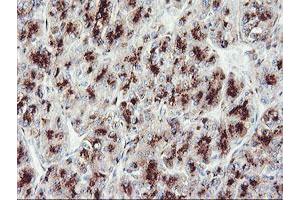 Immunohistochemical staining of paraffin-embedded Carcinoma of Human liver tissue using anti-GOLM1 mouse monoclonal antibody. (GOLM1 Antikörper)