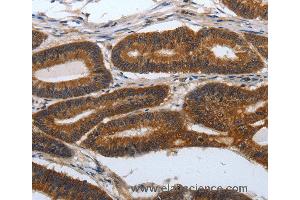 Immunohistochemistry of Human lung cancer using PDCD7 Polyclonal Antibody at dilution of 1:60 (PDCD7 Antikörper)