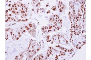 IHC-P Image Immunohistochemical analysis of paraffin-embedded human ovarian cancer, using C/EBP beta, antibody at 1:250 dilution. (CEBPB Antikörper  (N-Term))