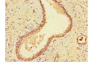 Immunohistochemistry of paraffin-embedded human prostate cancer using ABIN7149795 at dilution of 1:100 (Destrin Antikörper  (AA 2-165))