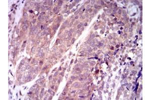 Immunohistochemical analysis of paraffin-embedded bladder cancer tissues using KEAP1 mouse mAb with DAB staining.