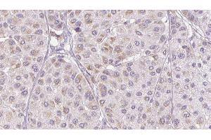 ABIN6276810 at 1/100 staining Human melanoma tissue by IHC-P. (PEDF Antikörper  (C-Term))