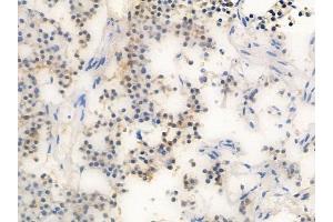 ABIN6257307 and ABIN6274300 at 1/100 staining human pituitary adenoma by IHC-P.