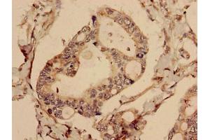 Immunohistochemistry analysis of human pancreatic cancer using ABIN7147768 at dilution of 1:100 (CFAP61 Antikörper  (AA 1-200))
