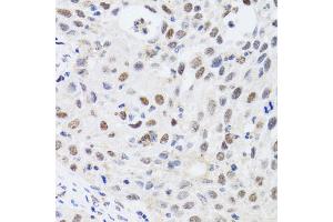 Immunohistochemistry of paraffin-embedded human lung cancer using CBX4 antibody. (CBX4 Antikörper)