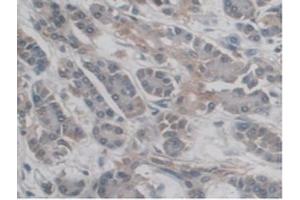 IHC-P analysis of Human Pancreas Cancer Tissue, with DAB staining. (DC-SIGN/CD209 Antikörper  (AA 70-404))