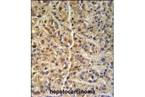 GNS Antibody (Center S298) IHC analysis in formalin fixed and paraffin embedded human hepatocarcinoma followed by peroxidase conjugation of the secondary antibody and DAB staining. (GNS Antikörper  (AA 283-313))