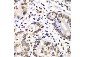 Immunohistochemistry of paraffin-embedded human gastric cancer using RBBP7 antibody (ABIN6290864) at dilution of 1:100 (40x lens). (RBBP7 Antikörper)