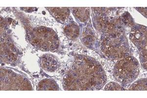 ABIN6277718 at 1/100 staining Human liver cancer tissue by IHC-P. (Occludin Antikörper)