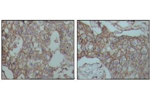 Immunohistochemical analysis of paraffin-embedded human breast carcinoma tissues, showing membrane localization with DAB staining using CD44 mouse mAb. (CD44 Antikörper)