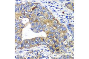 Immunohistochemistry of paraffin-embedded human gastric cancer using ARFGAP1 antibody at dilution of 1:100 (x40 lens). (ARFGAP1 Antikörper)