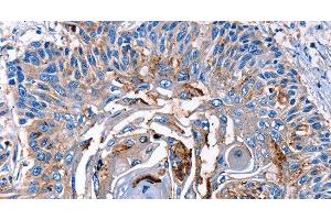 Immunohistochemistry of paraffin-embedded Human esophagus cancer tissue using LRP2 Polyclonal Antibody at dilution 1:40 (LRP2 Antikörper)