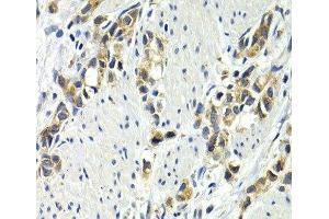 Immunohistochemistry of paraffin-embedded Human gastric cancer using WNT3A Polyclonal Antibody at dilution of 1:200 (40x lens). (WNT3A Antikörper)