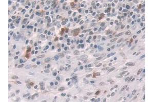 DAB staining on IHC-P; Samples: Human Colorectal cancer Tissue (Glucocorticoid Receptor Antikörper  (AA 532-730))
