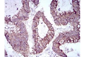 Immunohistochemical analysis of paraffin-embedded colon cancer tissues using SNAI2 mouse mAb with DAB staining. (SLUG Antikörper  (AA 100-200))