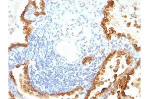 Formalin-fixed, paraffin-embedded human lung carcinoma stained with Cytokeratin 8 + 18 antibody (KRT8/803 + KRT18/835). (Cytokeratin 8/18 Antikörper)
