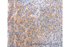 Immunohistochemistry of Human cervical cancer using ADHFE1 Polyclonal Antibody at dilution of 1:60