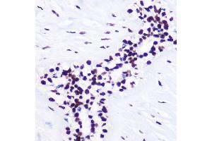 Immunohistochemistry of paraffin-embedded Human breast cancer using TriMethyl-Histone H3-K36 Rabbit pAb (ABIN3016038, ABIN3016039, ABIN3016040, ABIN1680217 and ABIN6219525) at dilution of 1:100 (40x lens). (Histone 3 Antikörper  (H3K36me3))