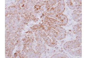 IHC-P Image Immunohistochemical analysis of paraffin-embedded human colon carcinoma, using GYG2, antibody at 1:500 dilution.