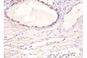 Immunohistochemistry of paraffin-embedded human prostate using BMP2 antibody at dilution of 1:100. (BMP2 Antikörper)