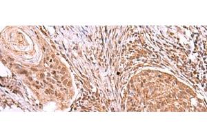 Immunohistochemistry of paraffin-embedded Human esophagus cancer tissue using IRX4 Polyclonal Antibody at dilution of 1:40(x200)
