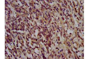 IHC image of ABIN7169549 diluted at 1:200 and staining in paraffin-embedded human gastric cancer performed on a Leica BondTM system. (NANS Antikörper  (AA 132-259))