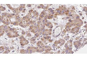 ABIN6272490 at 1/100 staining Human liver cancer tissue by IHC-P. (CACNA1G Antikörper  (N-Term))