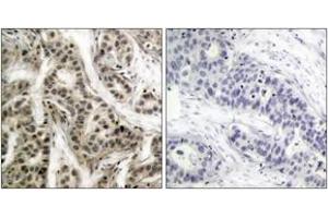 Immunohistochemistry analysis of paraffin-embedded human breast carcinoma, using NF-kappaB p105/p50 (Phospho-Ser337) Antibody. (NFKB1 Antikörper  (pSer337))