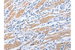 The image on the left is immunohistochemistry of paraffin-embedded Human gastric cancer tissue using ABIN7190790(GFRA4 Antibody) at dilution 1/40, on the right is treated with synthetic peptide. (GFRA4 Antikörper)