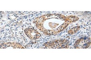 Immunohistochemistry of paraffin-embedded Human cervical cancer tissue using ZPBP Polyclonal Antibody at dilution of 1:30(x200) (ZPBP Antikörper)