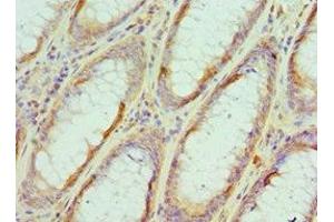 Immunohistochemistry of paraffin-embedded human colon cancer using ABIN7152105 at dilution of 1:100 (EIF4A1 Antikörper  (AA 167-406))