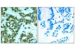 Immunohistochemical analysis of paraffin-embedded human lung carcinoma tissue using PKCth(Phospho-Ser676) Antibody(left) or the same antibody preincubated with blocking peptide(right). (PKC theta Antikörper  (pSer676))