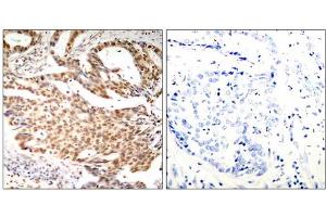 Immunohistochemical analysis of paraffin-embedded human breast carcinoma tissue using MEF2A (Phospho-Ser408) antibody (E011309). (MEF2A Antikörper  (pSer408))
