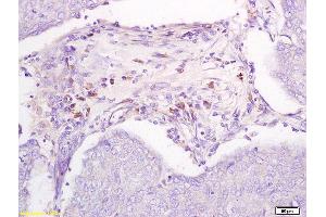 Formalin-fixed and paraffin embedded ovarian cancer xenograft labeled with Anti-DBC2 receptor Polyclonal Antibody, Unconjugated (ABIN706241) followed by conjugation to the secondary antibody and DAB staining (RHOBTB2 Antikörper  (AA 631-727))