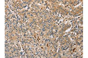 The image on the left is immunohistochemistry of paraffin-embedded Human gastric cancer tissue using ABIN7128517(ARL8A Antibody) at dilution 1/20, on the right is treated with fusion protein. (ARL8A Antikörper)