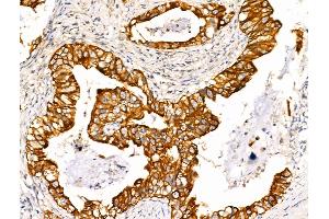 ABIN6265728 and ABIN6266730 at 1/100 staining Human lung cancer by IHC-P. (TRIM16 Antikörper  (N-Term))