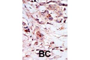 Formalin-fixed and paraffin-embedded human cancer tissue reacted with NPR1 polyclonal antibody  , which was peroxidase-conjugated to the secondary antibody, followed by AEC staining. (NPR1 Antikörper  (N-Term))