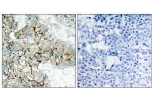 Immunohistochemical analysis of paraffin-embedded human breast carcinoma tissue using Integrin b3(Phospho-Tyr773) Antibody(left) or the same antibody preincubated with blocking peptide(right). (Integrin beta 3 Antikörper  (pTyr773))