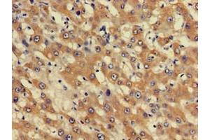 Immunohistochemistry of paraffin-embedded human liver cancer using ABIN7163052 at dilution of 1:100 (PHF21A Antikörper  (AA 312-487))