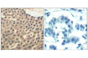 Immunohistochemical analysis of paraffin-embedded human lung carcinoma tissue using HDAC4/HDAC5/HDAC9(Ab-246/259/220) Antibody(left) or the same antibody preincubated with blocking peptide(right). (HDAC4/HDAC5/HDAC9 Antikörper)