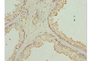 Immunohistochemistry of paraffin-embedded human prostate cancer using ABIN7169213 at dilution of 1:100 (ULK3 Antikörper  (AA 44-240))